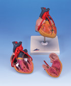 Классическая модель сердце с шунтированием, 2 части